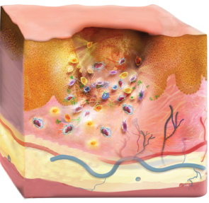 Illustrated cross-section of skin after Apligraf treatment