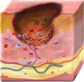 Illustrated cross-section of skin before Apligraf treatment