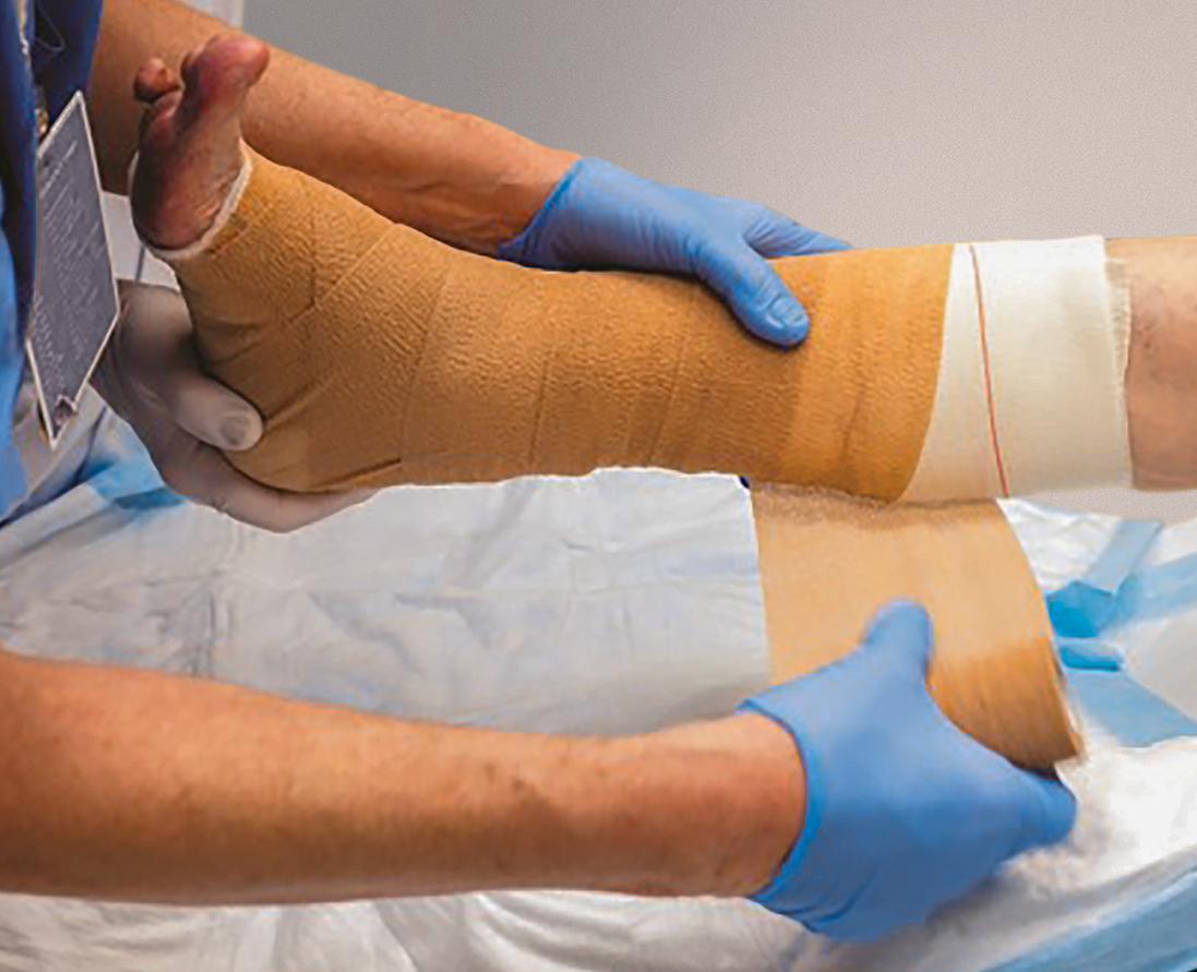 Doctor wrapping a leg in compression after applying Apligraf